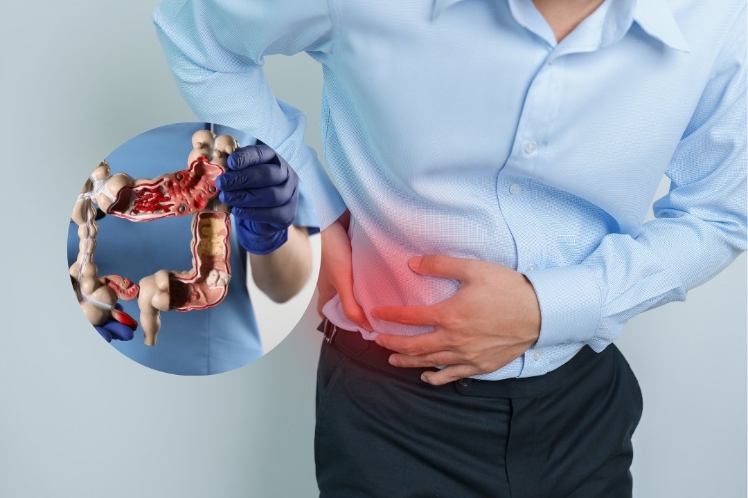 Rectal Cancer Risk Factors and Preventive Care in Mumbai