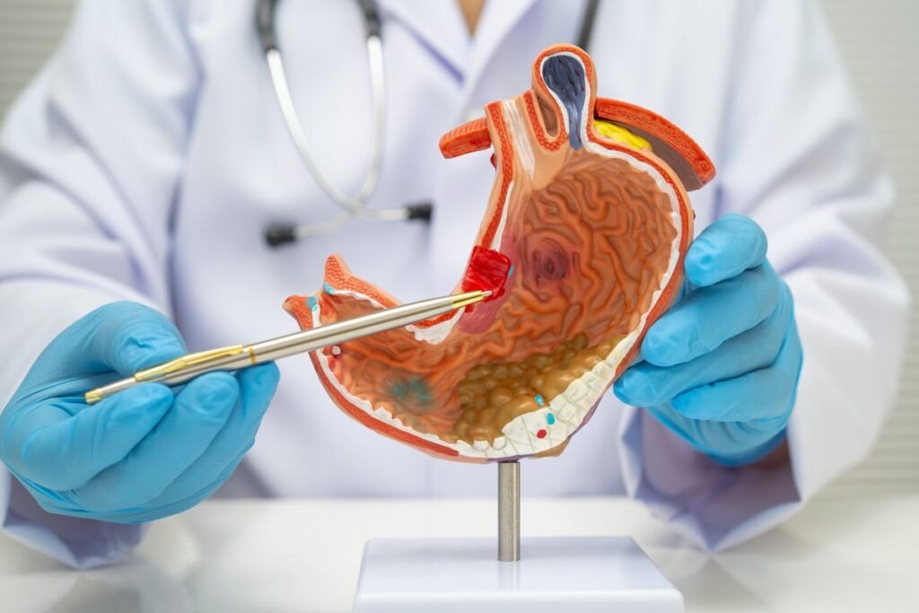 Stomach cancer