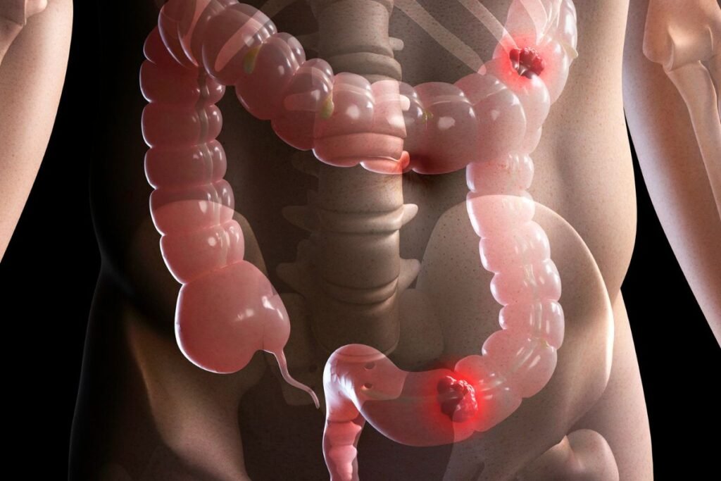 colorectal cancer